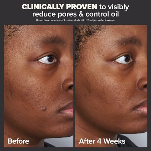 Side-by-side comparison of skin before and after 4 weeks of treatment, showing reduced pores and oil control.